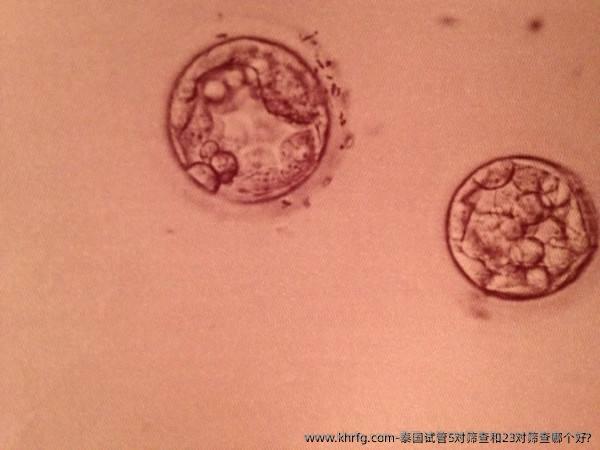 泰国试管5对筛查和23对筛查哪个好?